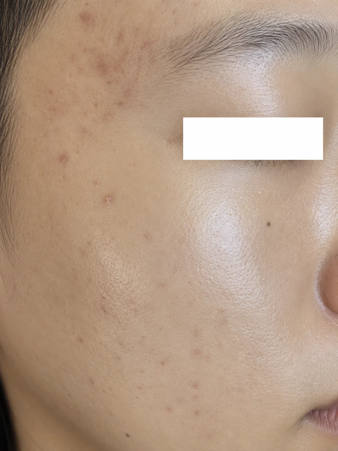 After brightening peel treatment