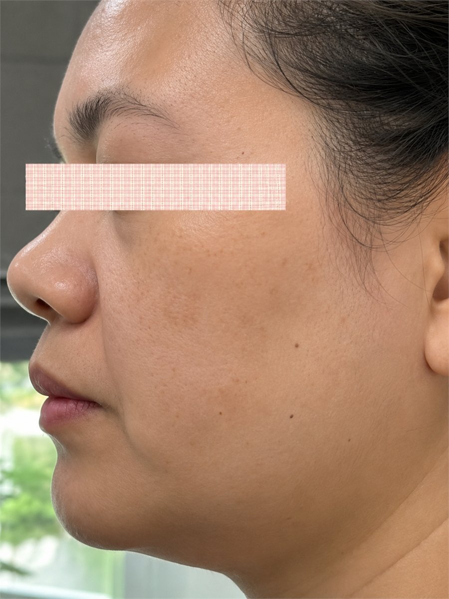 Before face slimming treatment