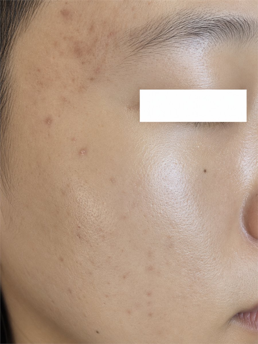 After brightening peel treatment