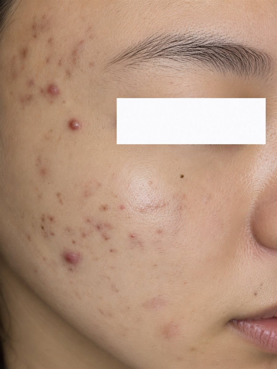 Before brightening peel treatment