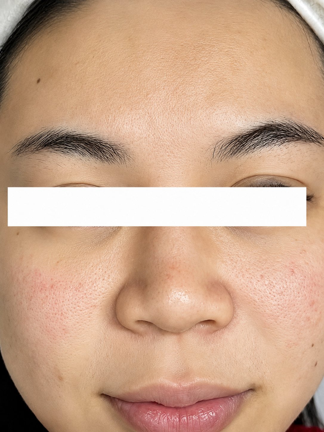 Before Pore Refining Facial